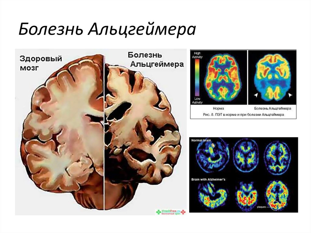 Мозги нормально. Болезнь Альцгеймера. Синдром Альцгеймера. Мозг при болезни Альцгеймера. Болезнь Альцгеймера больные.