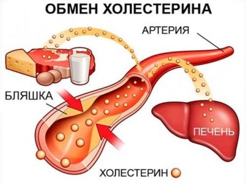 Атеросклероз (холестериновые бляшки) – частая причина повреждения сосудов