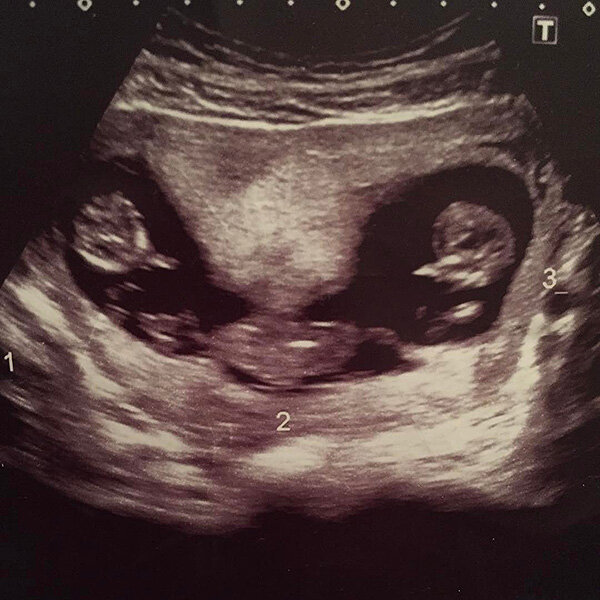 Снимок УЗИ, 9 недель 