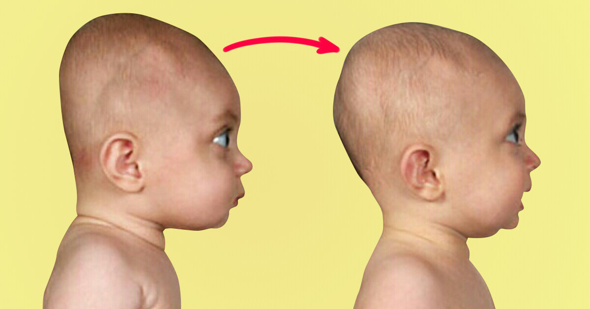 Плоская голова у ребенка: плагиоцефалия | Baby блог | Дзен