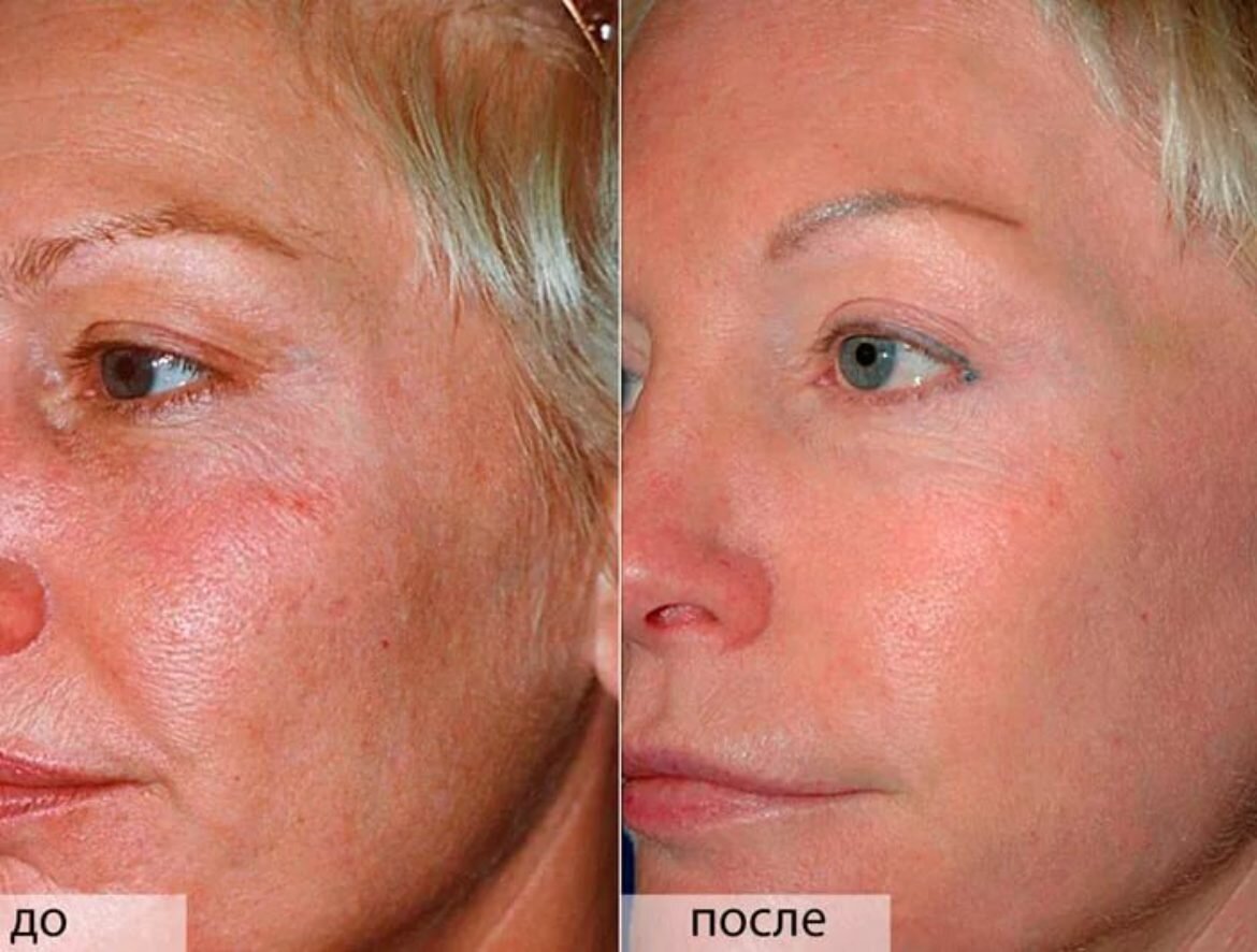 Молочный пилинг для лица: преимущества и применение в косметологии