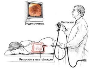 Определяет этиологию возникших кровопотерь из прямой кишки, что может быть вызвано наличием анальных трещин, полип, геморроидальных узлов и запущенной формой рака;