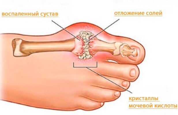 Мочевая кислота - как убрать из организма