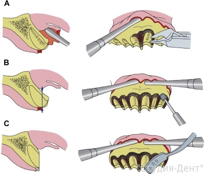 Альвеолярный гребень верхней и нижней челюсти, атрофия и пластика — ROOTT