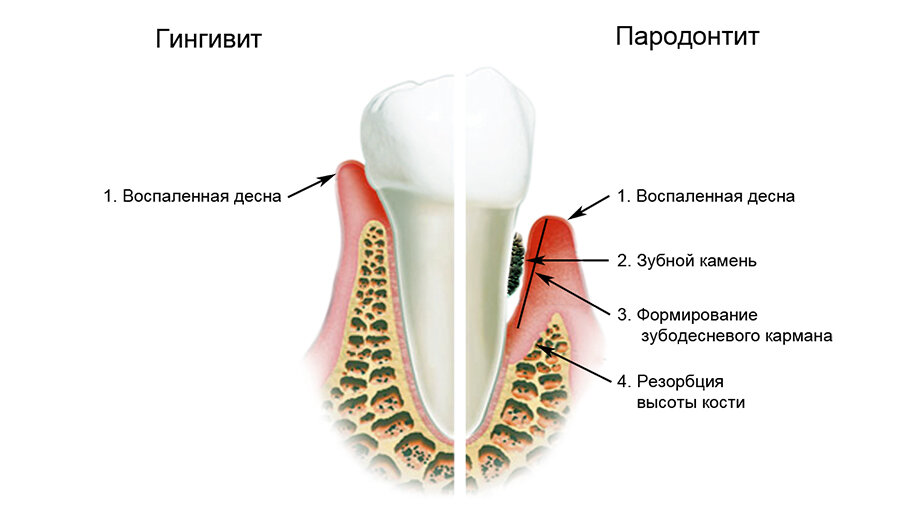 Как лечить пародонтоз