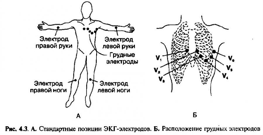 Как правильно наложить электроды экг фото пошагово
