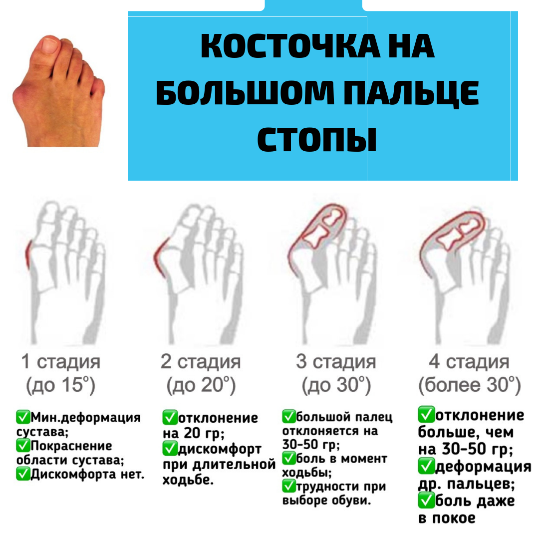 Лечение косточки на пальце отзывы