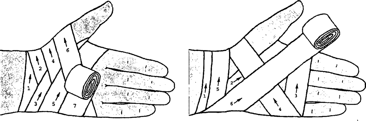 Ранение пальцев кисти повязка. Перевязка запястья эластичным бинтом. Колосовидная повязка на кисть. Повязка на лучезапястный сустав десмургия. Крестообразная повязка на лучезапястный сустав алгоритм.