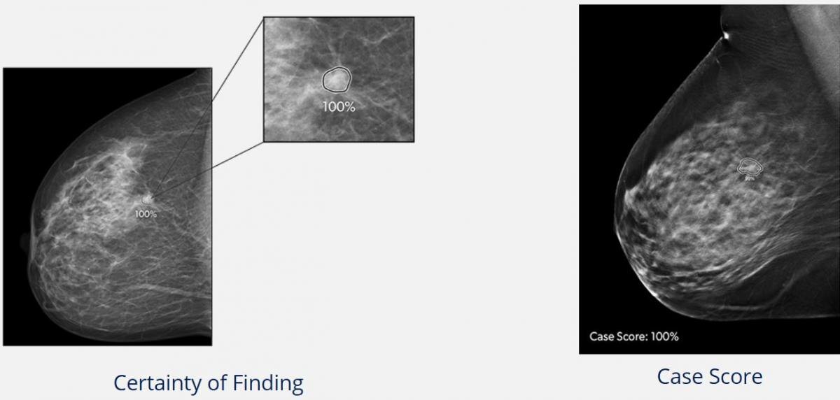 ProFound AI for 2D Mammography для диагностики рака груди 