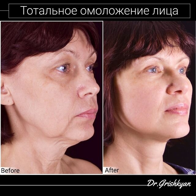 Тотальное омоложение лица. Имеются противопоказания, требуется консультация специалиста
