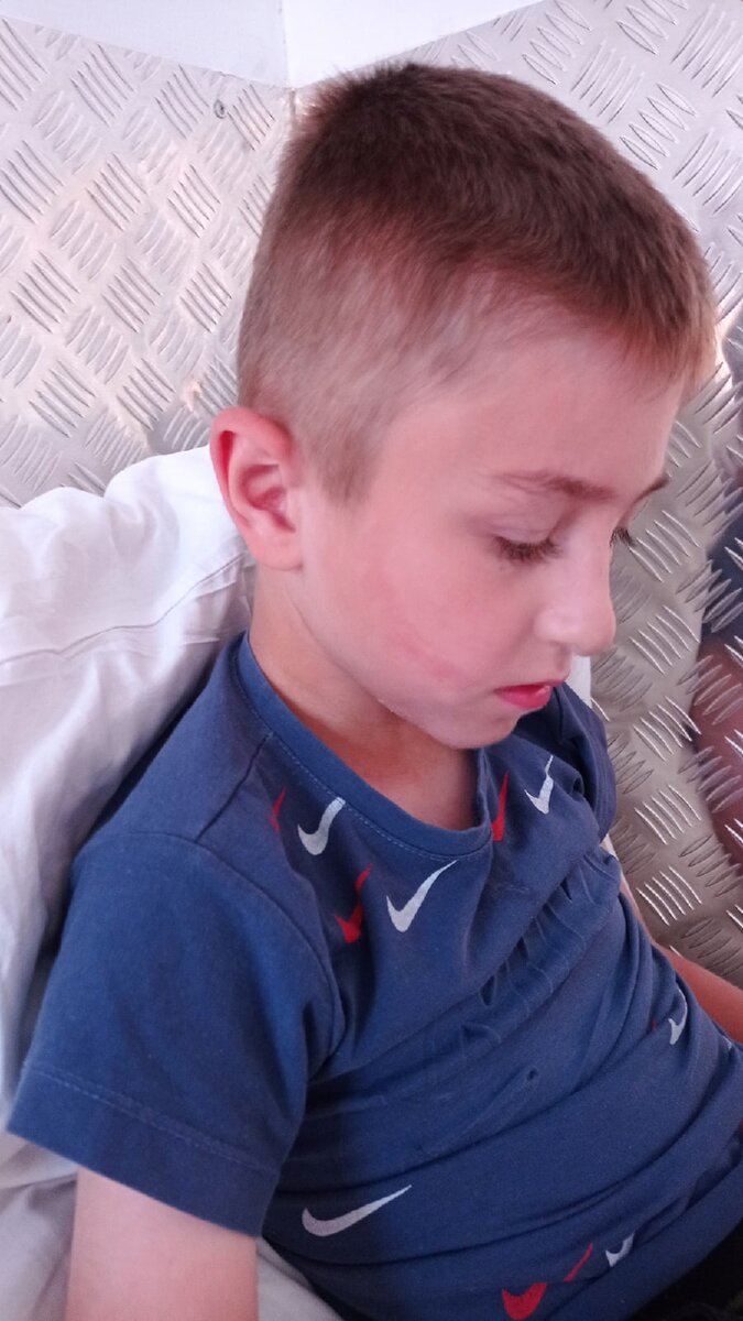 Следы от маски исчезли только через день