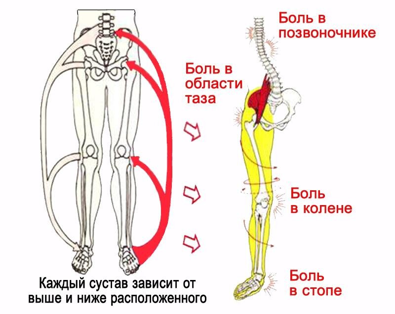 Перекос таза (тазовых костей): причины и последствия - центр «Остеопат»