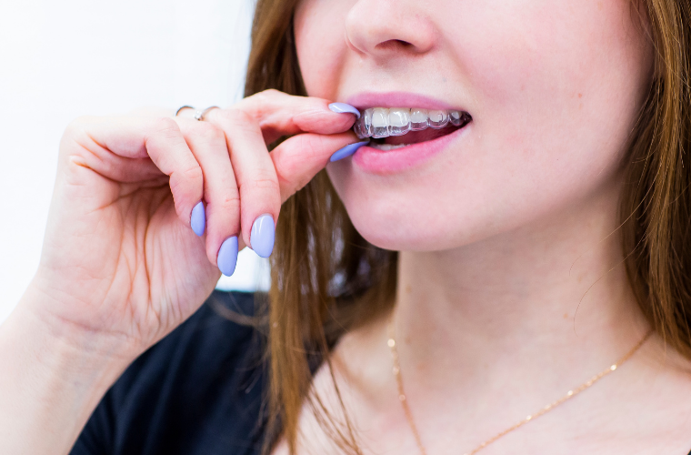 В некоторых случаях элайнеры можно снимать на непродолжительное время