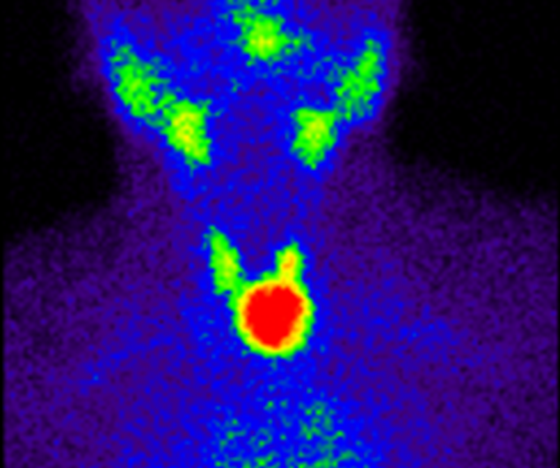 гипотиреоз сцинтиграфия. сцинтиграфия щитовиднойжелзы. сцинтиграфия щитовидной железы в спб. аденома щитовидной железы на сцинтиграфии. сцинтиграфия щитовидной железы.