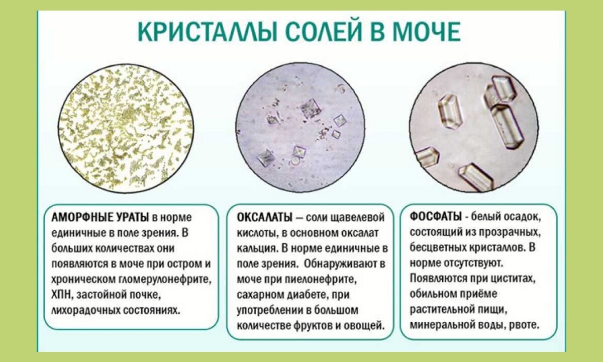 Оксалаты в суточной моче