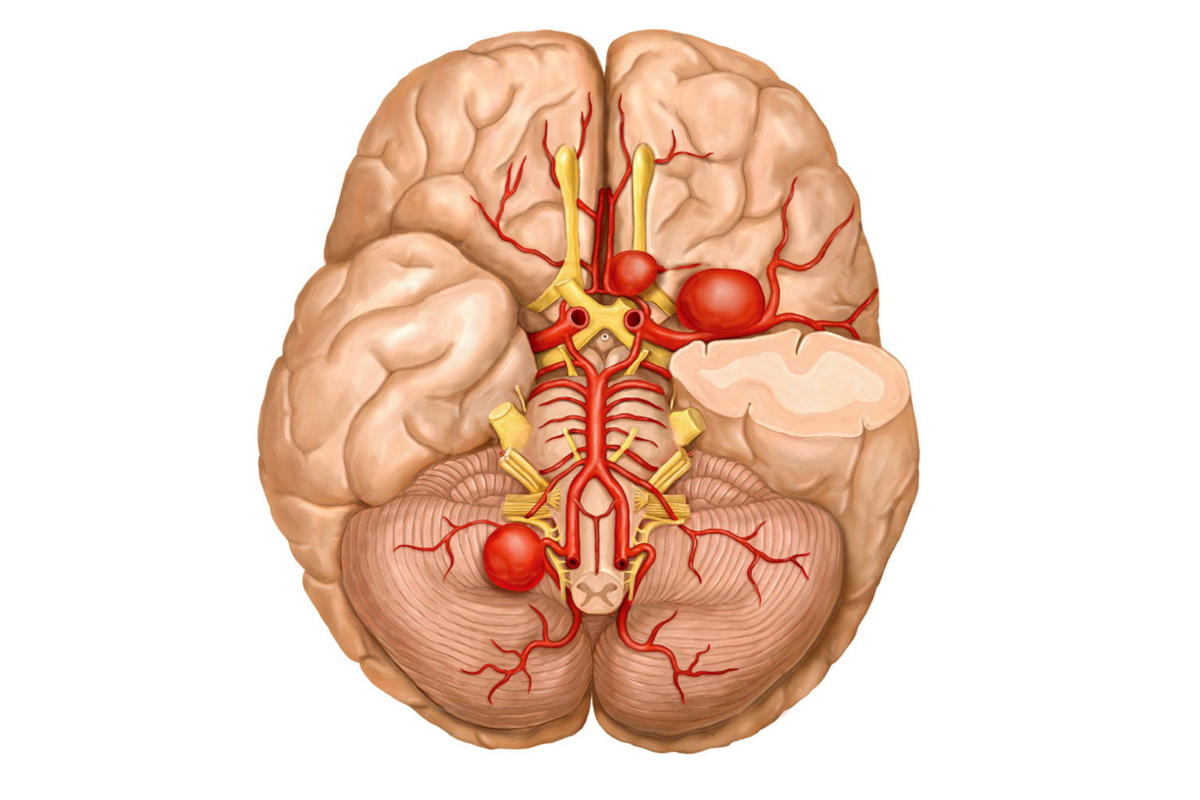 Проведенные на головном мозге. Аневризм артерий головного мозга. Аневризма головного сосудов головного мозга. Аневризма передней соединительной артерии головного мозга. Аневризмы сосудов головного мозга симптомы.