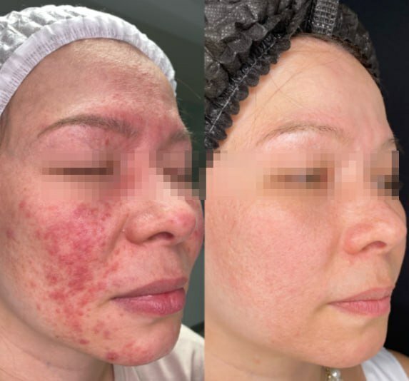 БЫЛО ПРОВЕДЕНО: Фототерапия, Биоревитализация, Мезотерапия и Пилинги. 