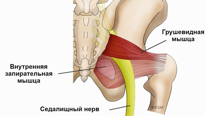 синдром грушевидной мышцы