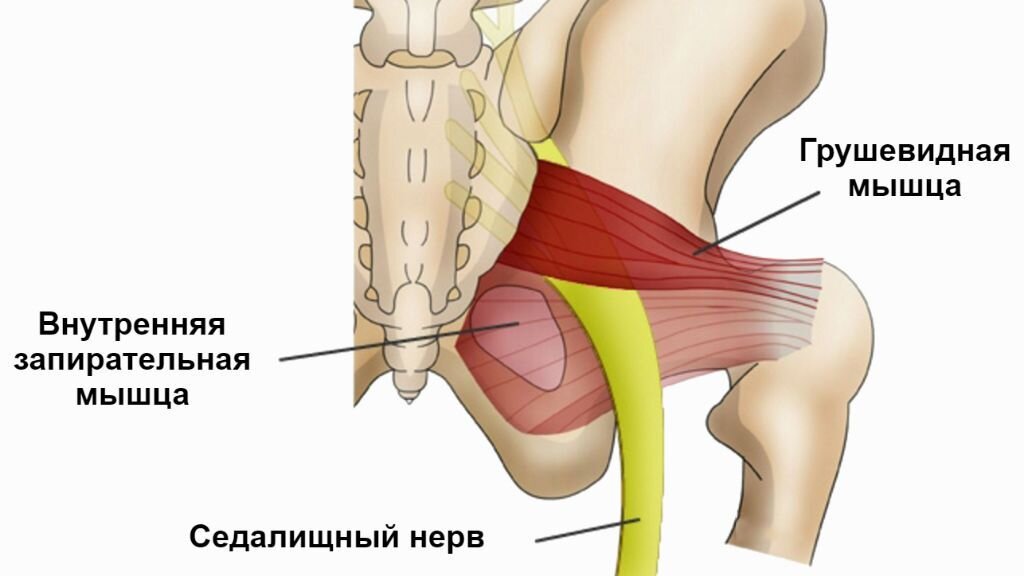 Боль в ягодице. Синдром грушевидной мышцы.