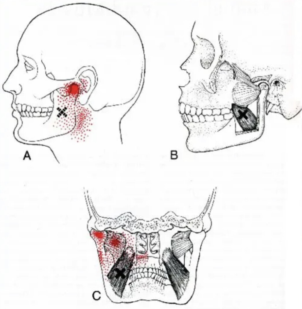 Тризм жевательных мышц нижней челюсти. Перелом челюсти подбородок. При острой боли челюсти. Нарушение функции внчс. Ревматоидный артрит внчс.