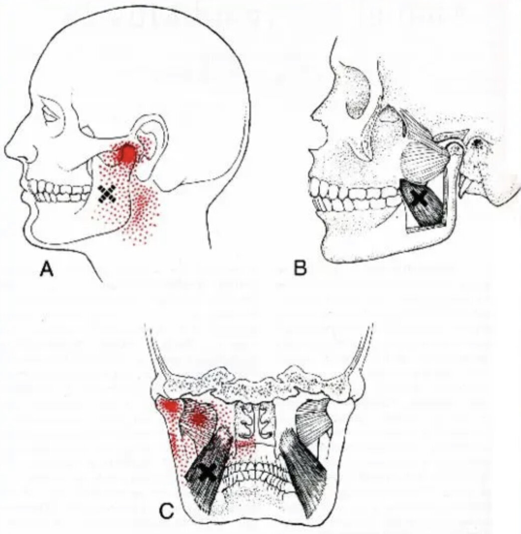 Болит челюсть возле уха. Крыловидная мышца триггерные точки. Триггерные точки мышц челюсти. Триггерные точки жевательных мышц при заболеваниях ВНЧС.
