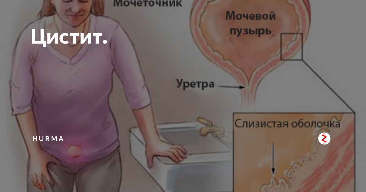 Как узнать что у тебя цистит