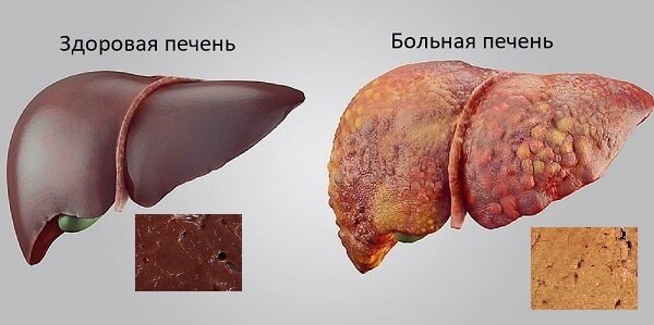 Здоровая и больная печень