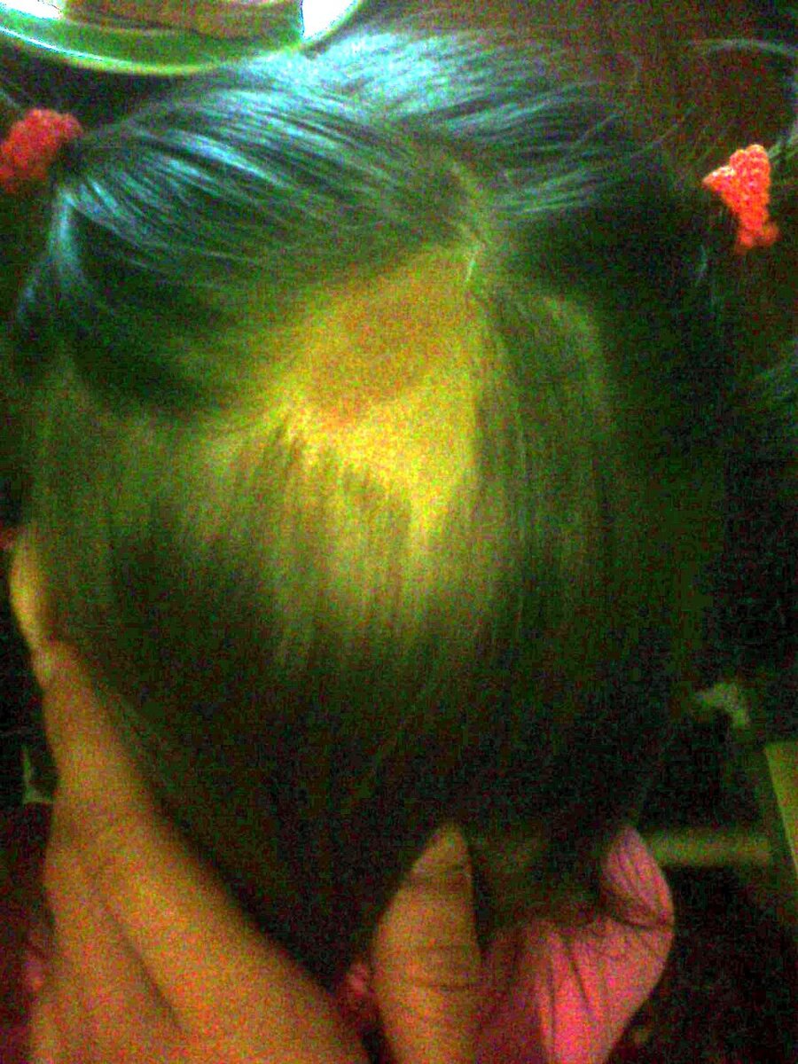 Сразу после того, как сбрила заражённые волосы. Это тёмное пятно- стригущий лишай, который мы прижгли йодом.