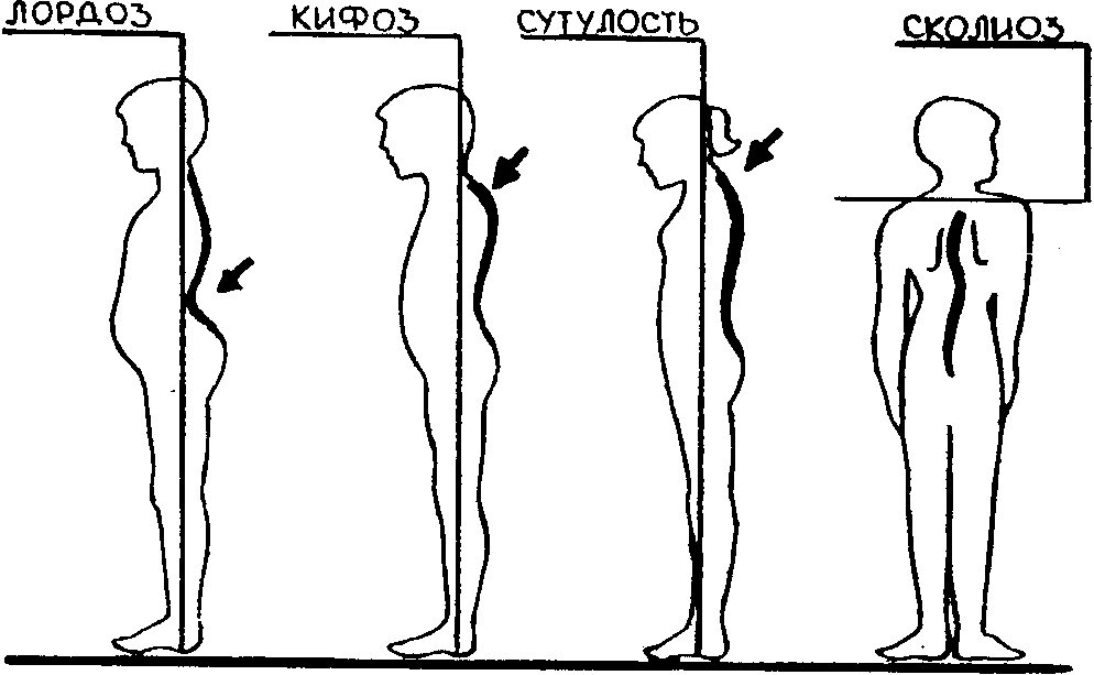 Рассмотрите рисунки 1 4 с изображением типов осанок человека как называют нарушение осанки