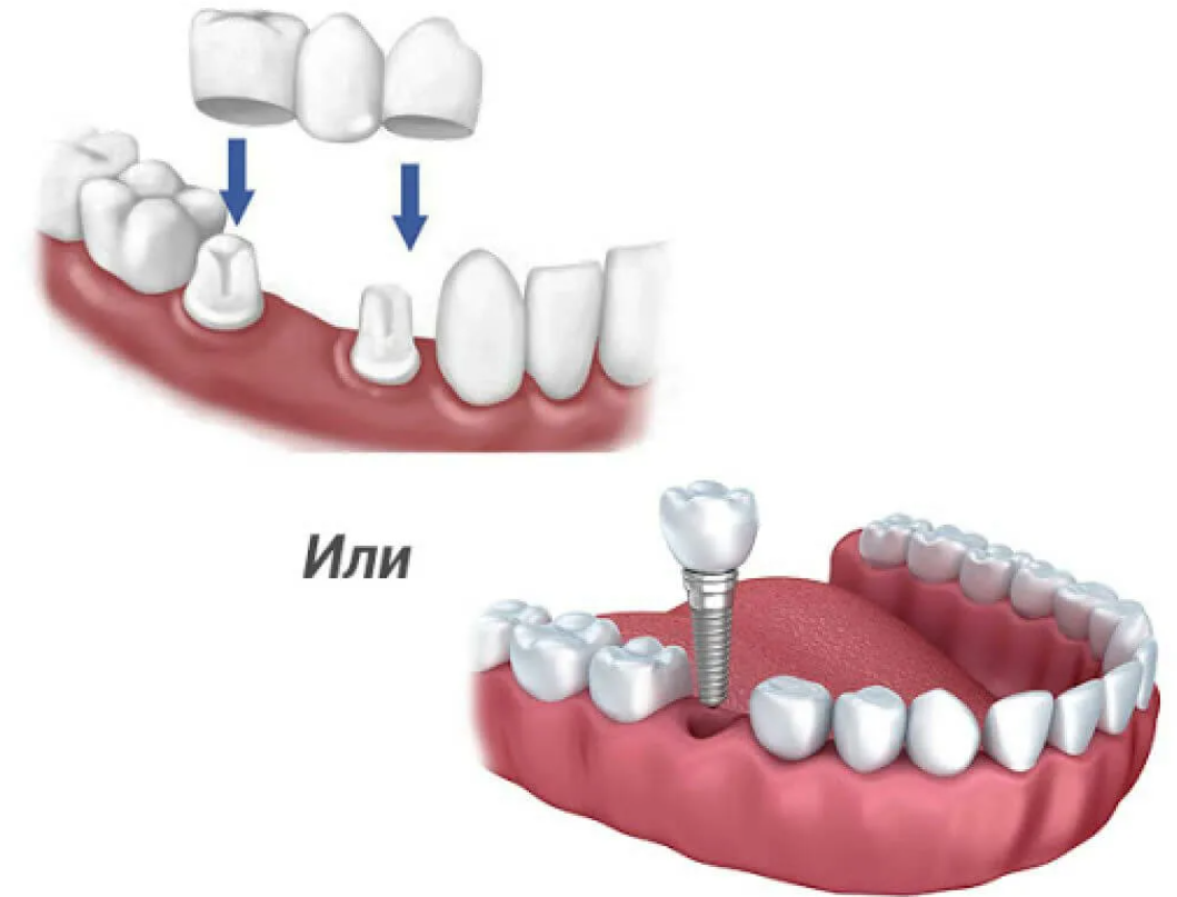 Мост на два зуба. Имплант или мостовидный протез. Имплантация зубов мостовидные протезы. Мостовидный протез на зуб и имплант. Мостовидный протез с опорой на 2 зуба.