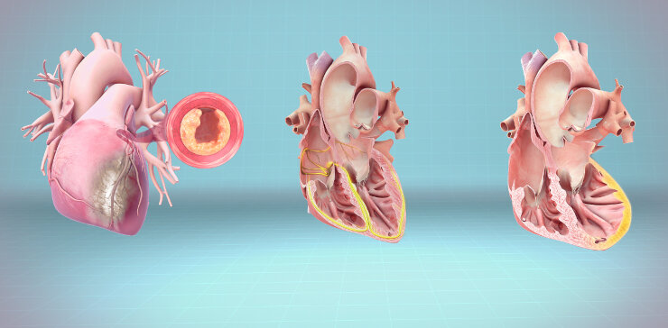 Изображения  сердца при сердечно-сосудистых болезнях: инфаркте миокарда, остановке  сердца и сердечной недостаточности. © CC BY-SA  4.0/www.scientificanimations.com/wiki-images/