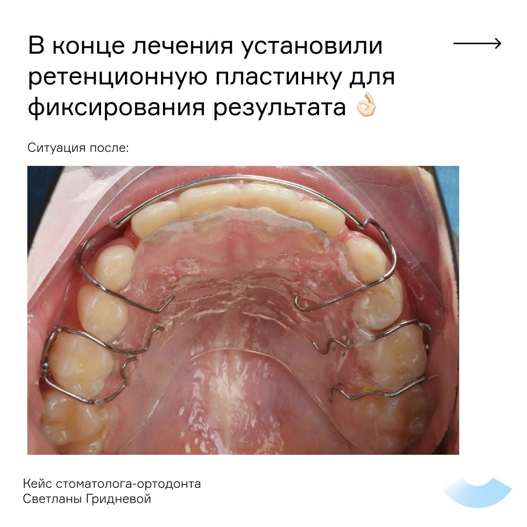 Почему надо ставить протез на место удаленного зуба?