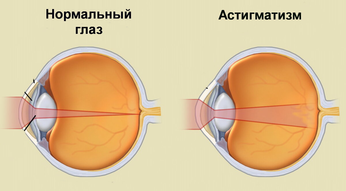 Нормальное зрение у человека