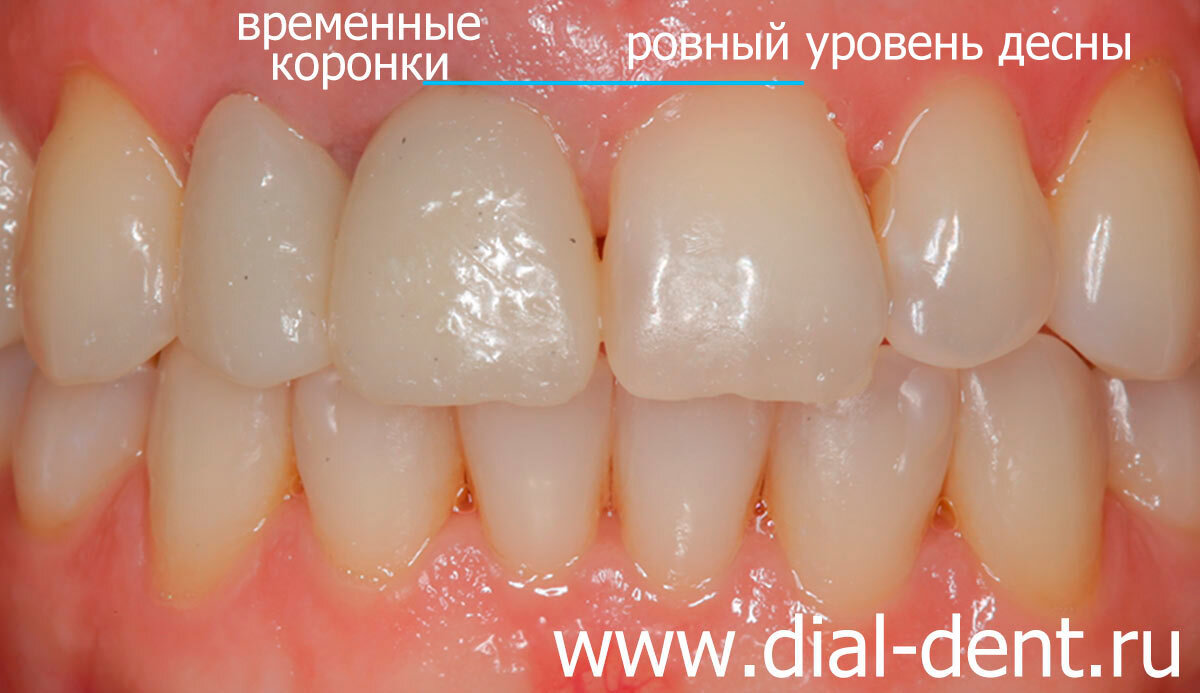 Хирургический диодный лазер GRANUM для стоматологии (Арт: ) - DentPro