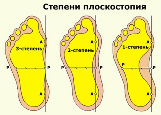 Степени плоскостопия