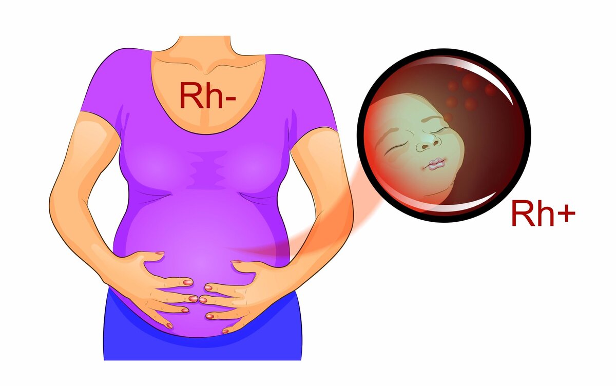 Отрицательный резус при беременности. Мифы и реалии. | Доктор Шилов:  Медицина. Спорт. Путешествия. | Дзен