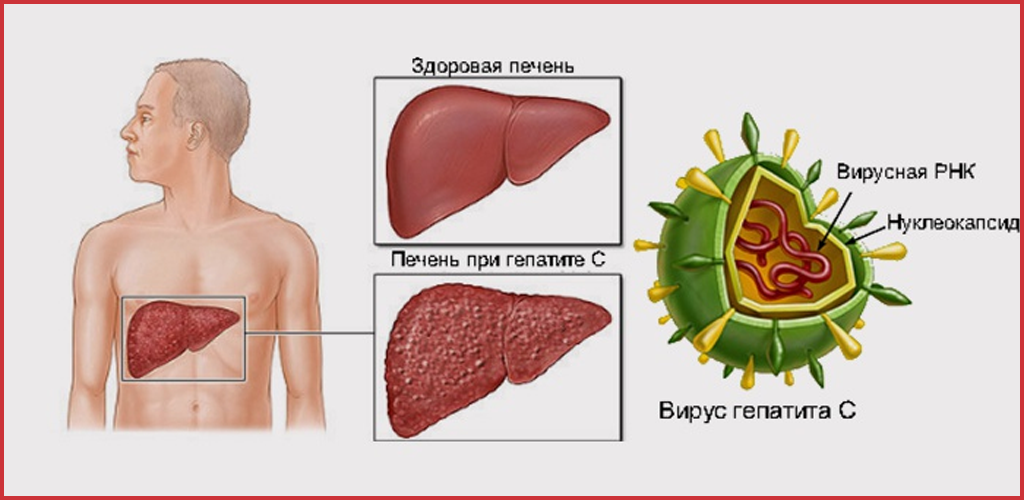 Хронический вирусный гепатит C - «Ласковый убийца»