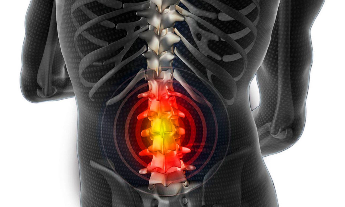 Hernia. Межпозвоночная грыжа. Спинная грыжа.