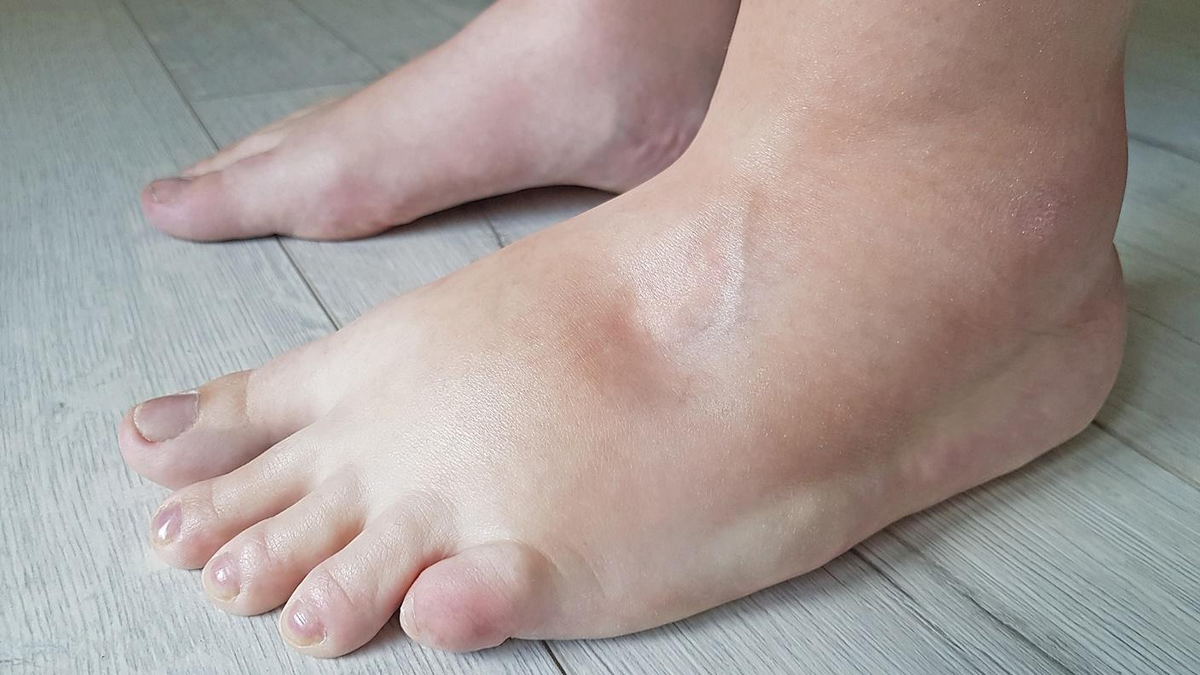 Отеки ног причины и лечение