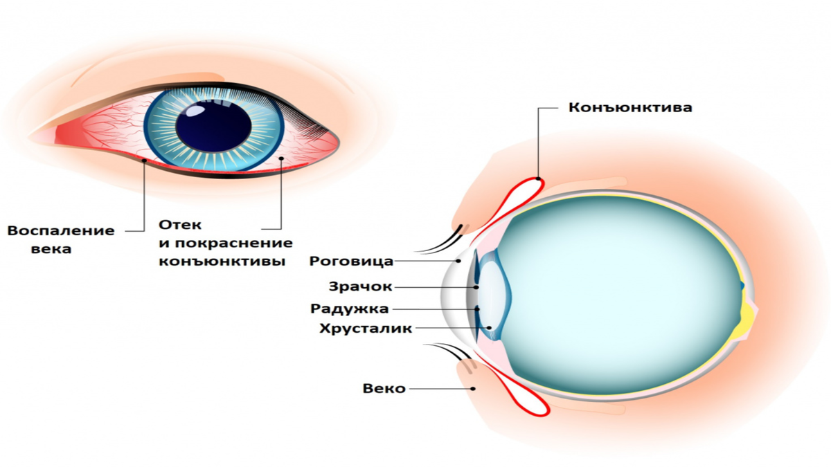 Конъюнктивиты схема