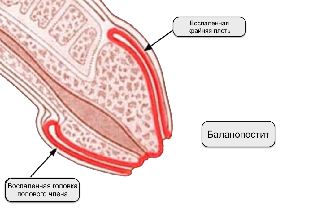 Баланит и баланопостит