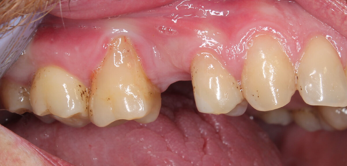 Оголение корня зуба: симптомы и лечение