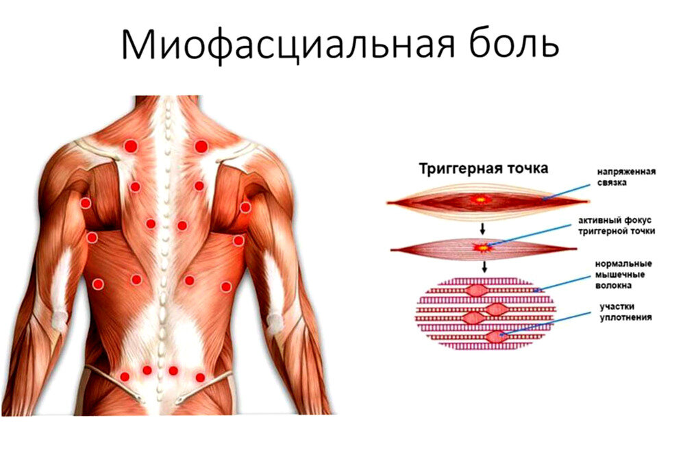 Спайки поясницы. Триггерные точки в мышцах спины. Триггерные точки схема. Миофасциальный синдром триггерные точки. Миофасциальный болевой синдром триггерные точки.