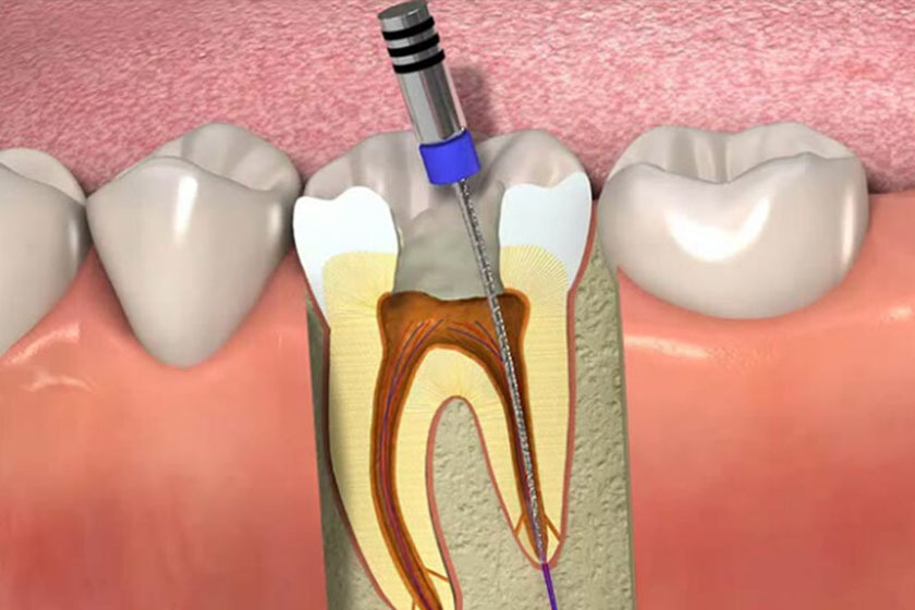 Удаление нерва в зубе – зачем, когда и как?