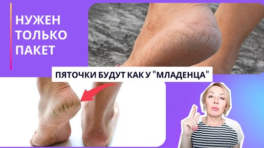 Пяточки будут как у 