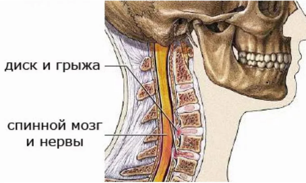 Дисков шейного отдела. С6 с7 шейного отдела позвоночника. 6 И 7 позвонки. Грыжа позвонка шейного отдела. Грыжа диска с6-с7 шейного отдела.