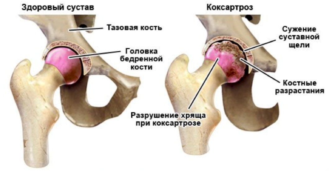 Коксартроз тазобедренного сустава 2 степени симптомы. Артроз болезнь Пертеса. Болезнь Пертеса тазобедренного сустава. Костный анкилоз тазобедренного сустава. Коксалгия тазобедренного сустава.