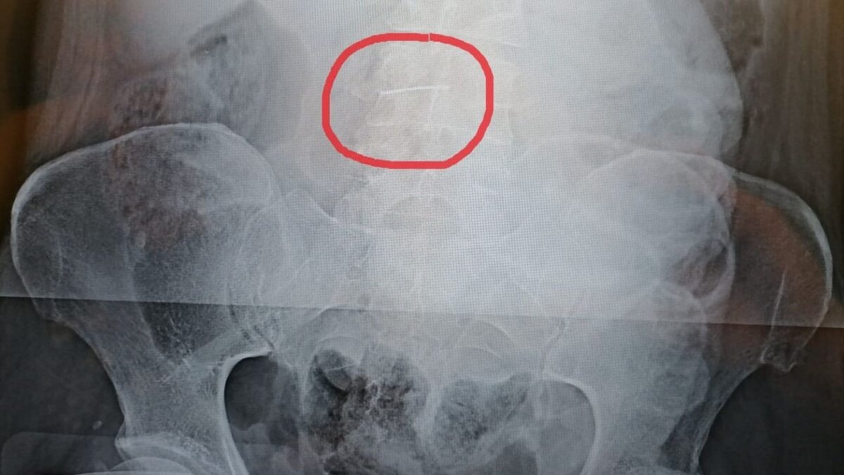     Операцию по удалению иглы из живота провели 42-летней волгоградке. Она прожила с ней 19 лет, причём обнаружили её врачи случайно.