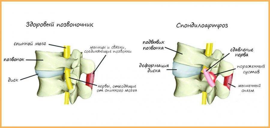 Протрузии дисков позвоночника спондилоартроз