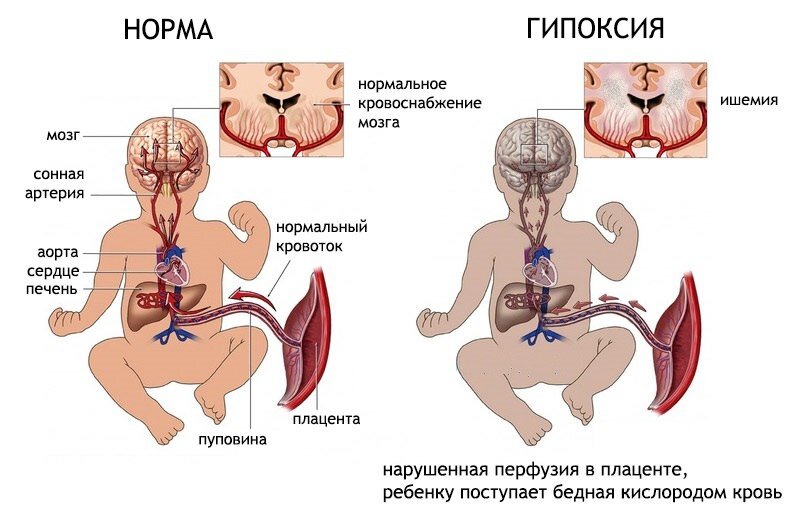 Гипоксия при беременности: признаки нехватки воздуха, профилактика анемии